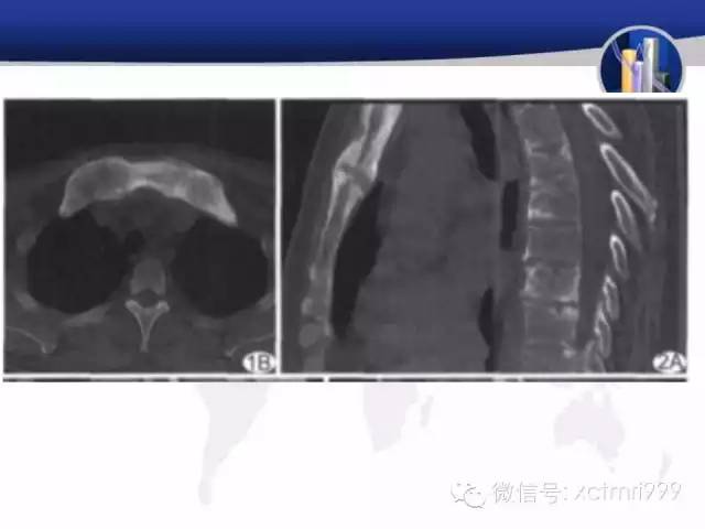 SAPHO综合征 SAPHO综合征