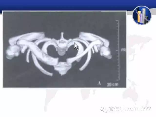 SAPHO综合征 SAPHO综合征