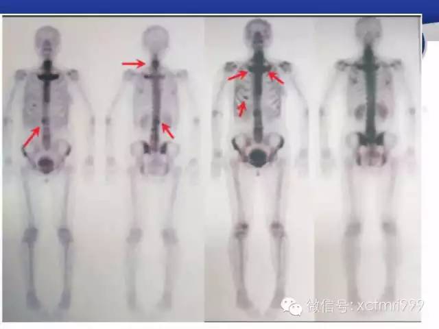 SAPHO综合征 SAPHO综合征