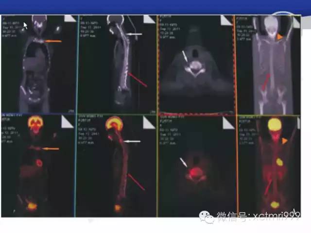SAPHO综合征 SAPHO综合征