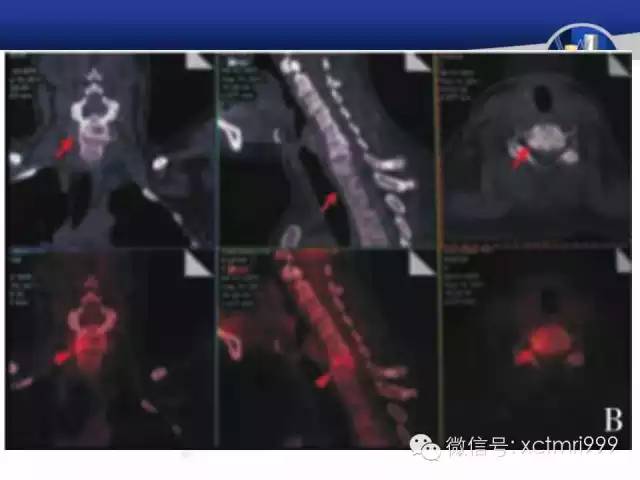 SAPHO综合征 SAPHO综合征