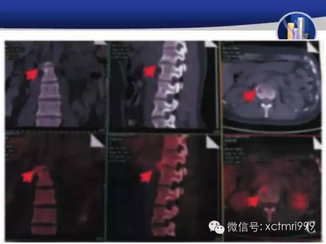 SAPHO综合征 SAPHO综合征