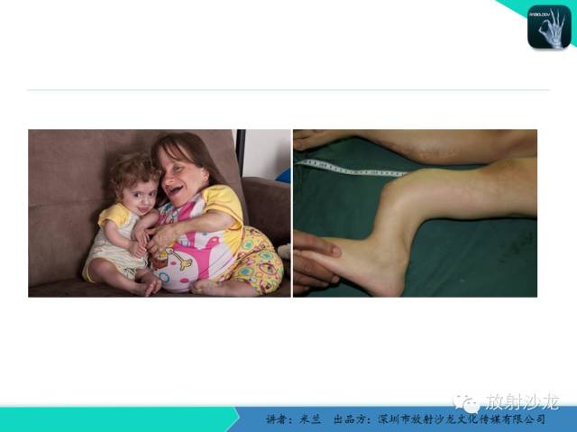 【PPT】脆骨病