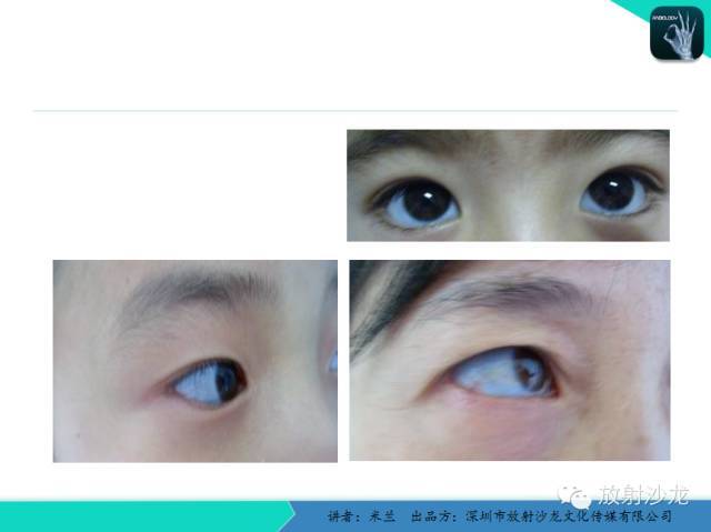 【PPT】脆骨病