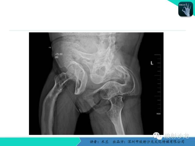 【PPT】脆骨病