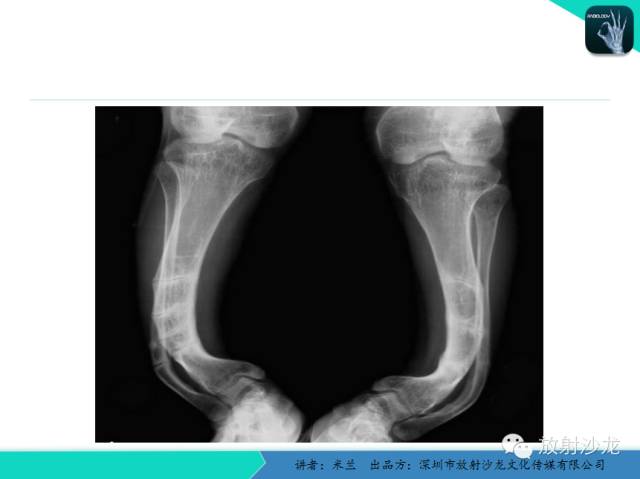 【PPT】脆骨病