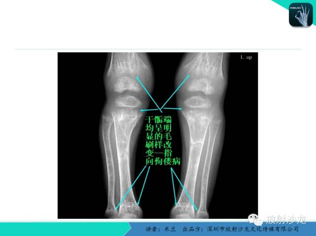 【PPT】脆骨病