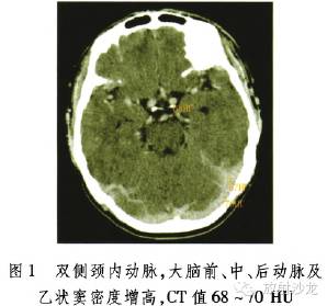 【病例】继发性红细胞增多症1例CT表现