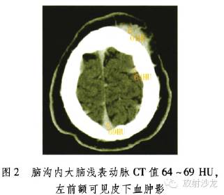 【病例】继发性红细胞增多症1例CT表现 【病例】继发性红细胞增多症1例CT表现