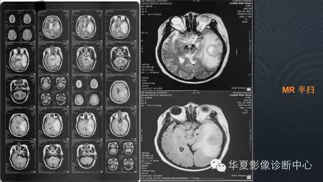 【病例】原发性中枢神经系统淋巴瘤1例MR影像表现
