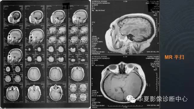 【病例】原发性中枢神经系统淋巴瘤1例MR影像表现