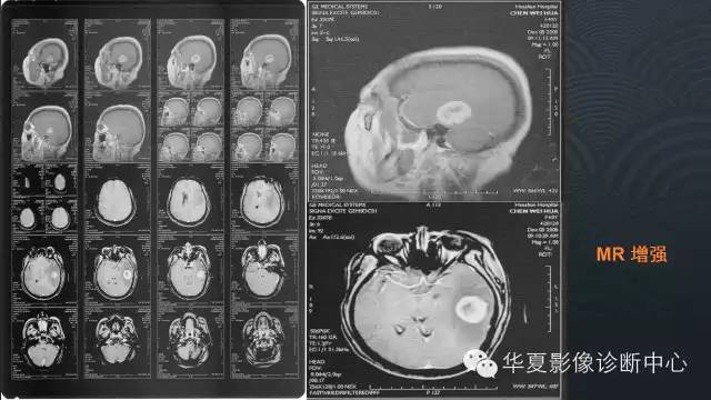 【病例】原发性中枢神经系统淋巴瘤1例MR影像表现
