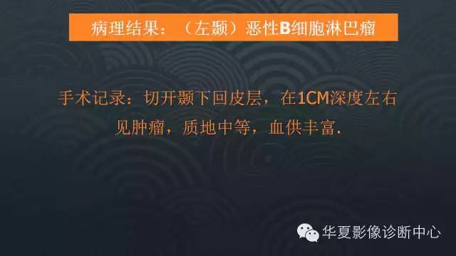 【病例】原发性中枢神经系统淋巴瘤1例MR影像表现