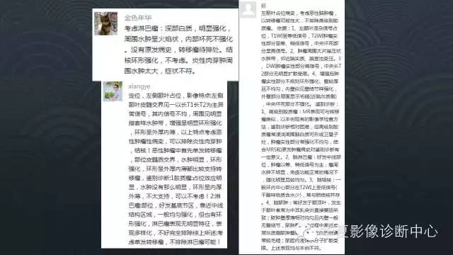 【病例】原发性中枢神经系统淋巴瘤1例MR影像表现
