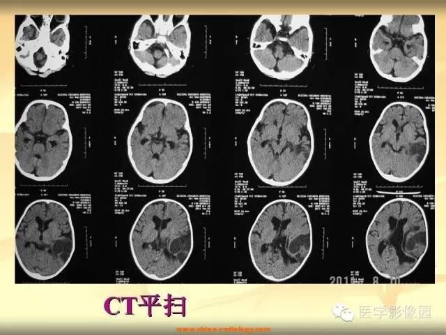 【病例】促纤维增生性星形细胞瘤1例CT及MR影像表现 【病例】促纤维增生性星形细胞瘤1例CT及MR影像表现