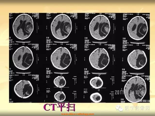 【病例】促纤维增生性星形细胞瘤1例CT及MR影像表现 【病例】促纤维增生性星形细胞瘤1例CT及MR影像表现
