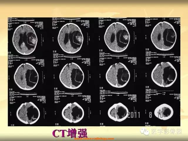 【病例】促纤维增生性星形细胞瘤1例CT及MR影像表现 【病例】促纤维增生性星形细胞瘤1例CT及MR影像表现