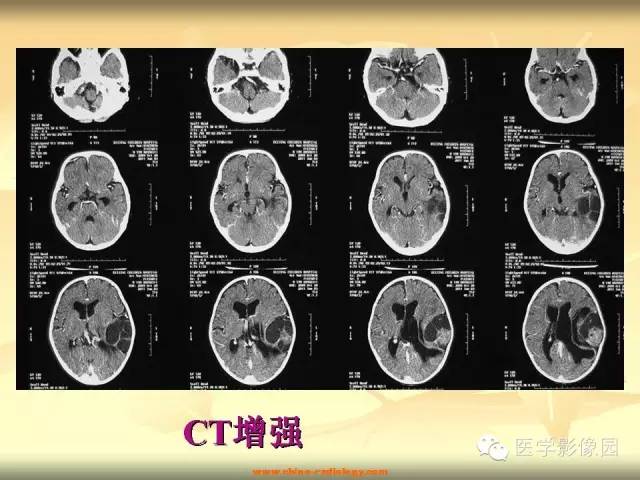 【病例】促纤维增生性星形细胞瘤1例CT及MR影像表现 【病例】促纤维增生性星形细胞瘤1例CT及MR影像表现