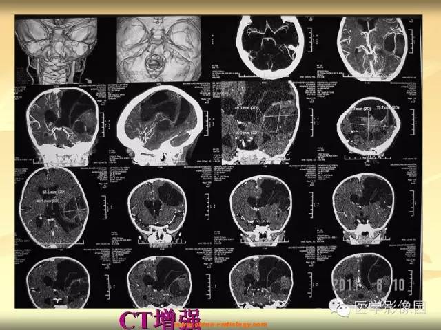 【病例】促纤维增生性星形细胞瘤1例CT及MR影像表现 【病例】促纤维增生性星形细胞瘤1例CT及MR影像表现