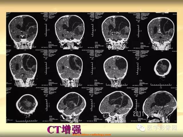【病例】促纤维增生性星形细胞瘤1例CT及MR影像表现 【病例】促纤维增生性星形细胞瘤1例CT及MR影像表现