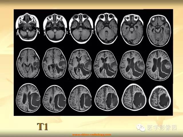 【病例】促纤维增生性星形细胞瘤1例CT及MR影像表现 【病例】促纤维增生性星形细胞瘤1例CT及MR影像表现