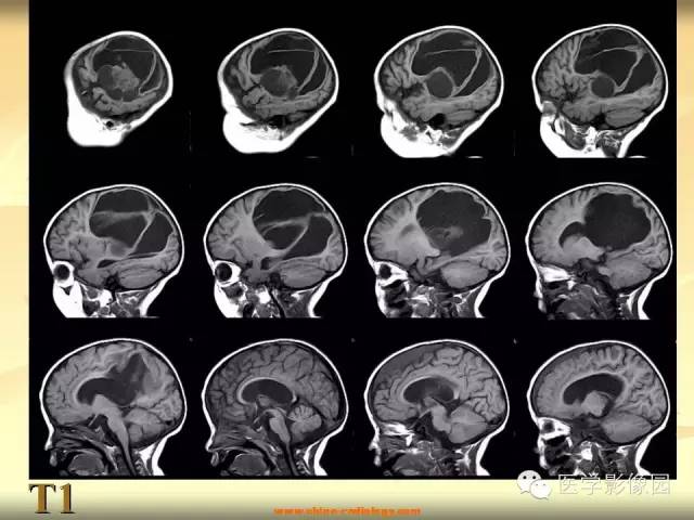 【病例】促纤维增生性星形细胞瘤1例CT及MR影像表现 【病例】促纤维增生性星形细胞瘤1例CT及MR影像表现