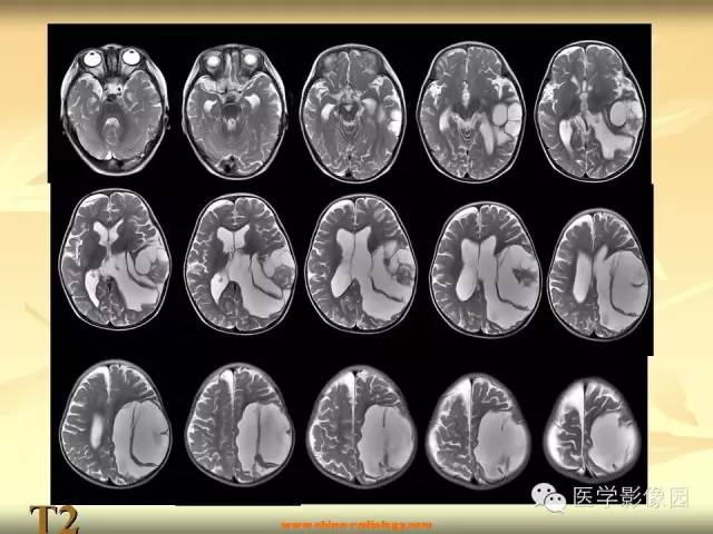 【病例】促纤维增生性星形细胞瘤1例CT及MR影像表现 【病例】促纤维增生性星形细胞瘤1例CT及MR影像表现