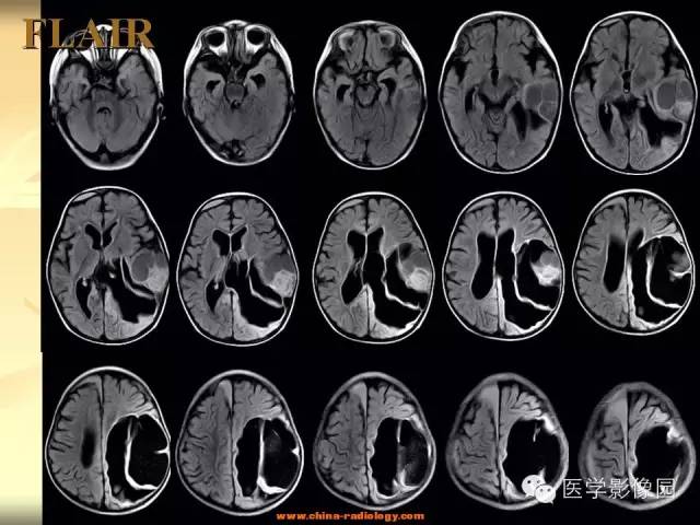 【病例】促纤维增生性星形细胞瘤1例CT及MR影像表现 【病例】促纤维增生性星形细胞瘤1例CT及MR影像表现
