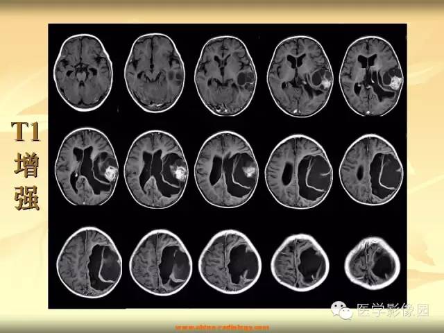 【病例】促纤维增生性星形细胞瘤1例CT及MR影像表现 【病例】促纤维增生性星形细胞瘤1例CT及MR影像表现