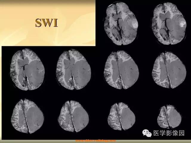 【病例】促纤维增生性星形细胞瘤1例CT及MR影像表现 【病例】促纤维增生性星形细胞瘤1例CT及MR影像表现