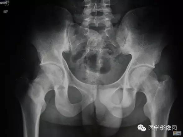 【病例】骨纤维结构不良1例