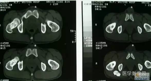 【病例】骨纤维结构不良1例 【病例】骨纤维结构不良1例