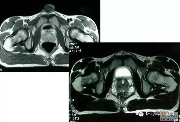【病例】骨纤维结构不良1例 【病例】骨纤维结构不良1例