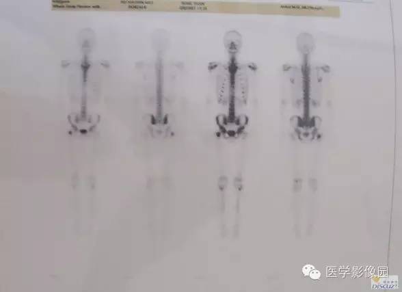 【病例】骨纤维结构不良1例 【病例】骨纤维结构不良1例