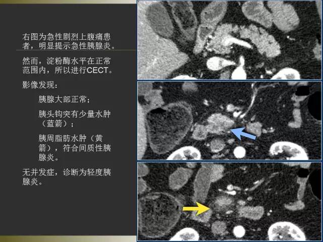 【PPT】急性胰腺炎亚特兰大分类2012年修订版