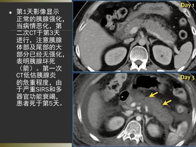 【PPT】急性胰腺炎亚特兰大分类2012年修订版