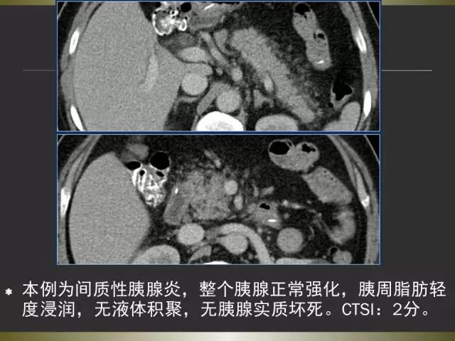 【PPT】急性胰腺炎亚特兰大分类2012年修订版