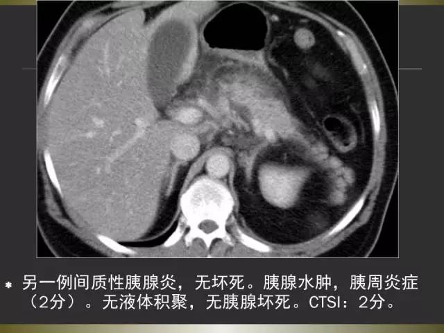 【PPT】急性胰腺炎亚特兰大分类2012年修订版