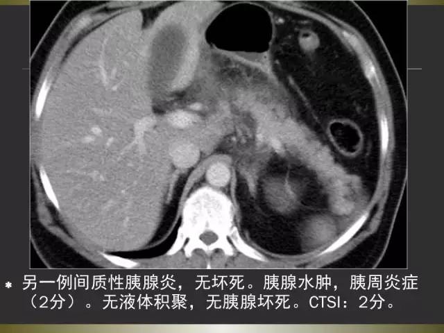 【PPT】急性胰腺炎亚特兰大分类2012年修订版