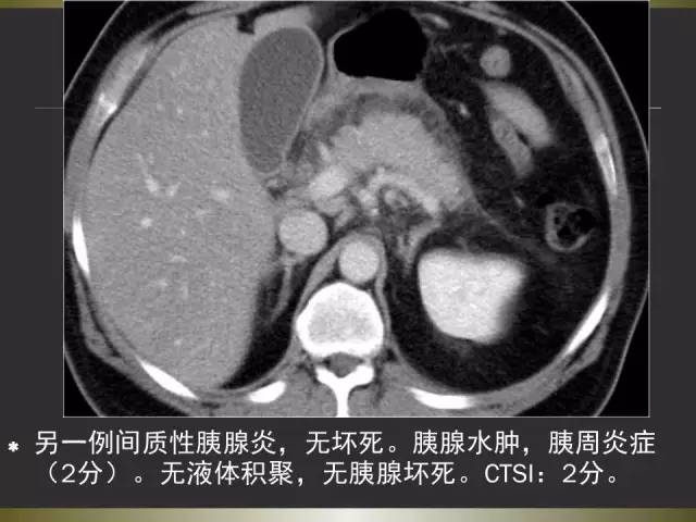 【PPT】急性胰腺炎亚特兰大分类2012年修订版
