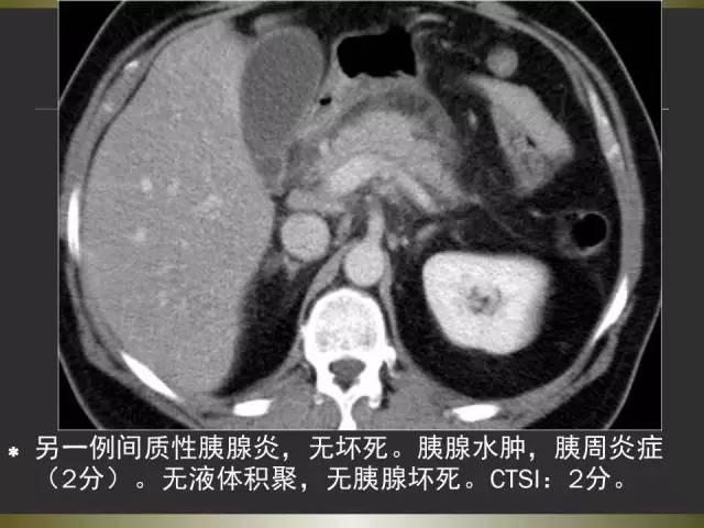 【PPT】急性胰腺炎亚特兰大分类2012年修订版
