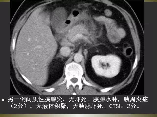 【PPT】急性胰腺炎亚特兰大分类2012年修订版