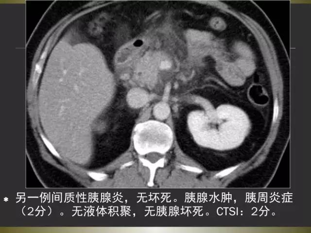 【PPT】急性胰腺炎亚特兰大分类2012年修订版