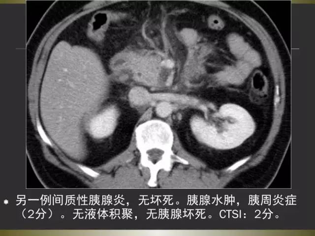 【PPT】急性胰腺炎亚特兰大分类2012年修订版