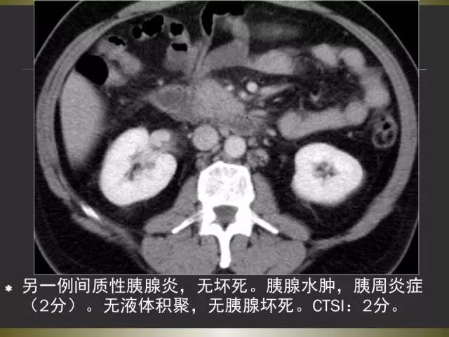 【PPT】急性胰腺炎亚特兰大分类2012年修订版