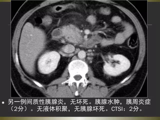 【PPT】急性胰腺炎亚特兰大分类2012年修订版