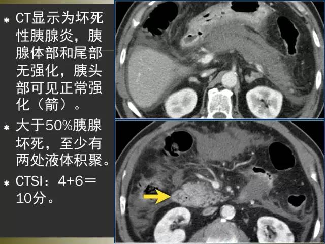 【PPT】急性胰腺炎亚特兰大分类2012年修订版