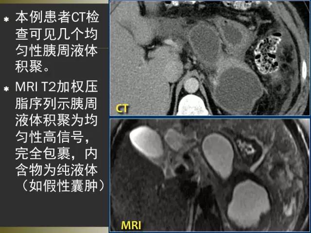 【PPT】急性胰腺炎亚特兰大分类2012年修订版