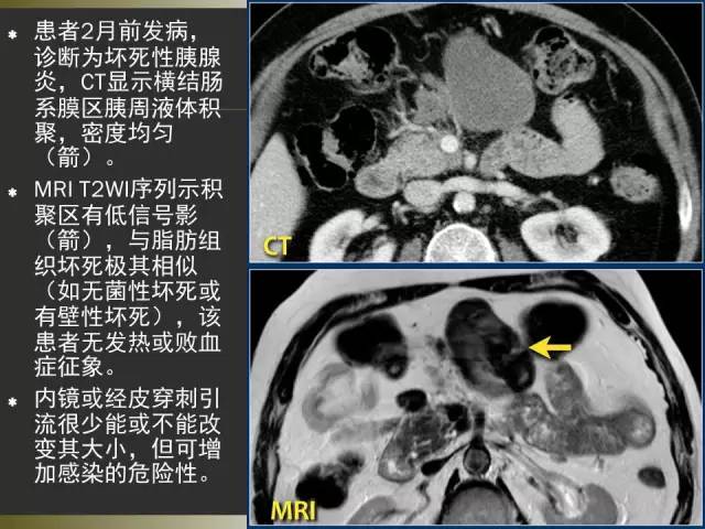【PPT】急性胰腺炎亚特兰大分类2012年修订版