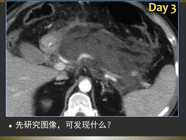 【PPT】急性胰腺炎亚特兰大分类2012年修订版